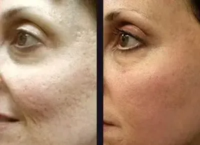Före och efter Microneedling 1
