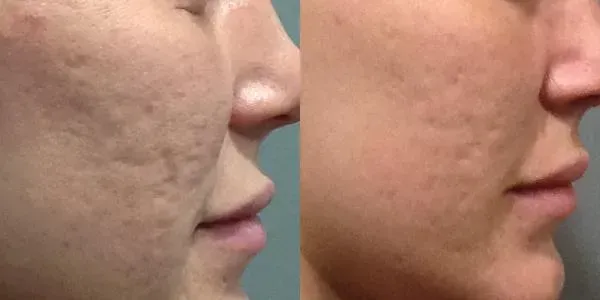Före och efter Microneedling 2