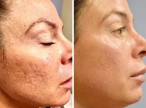 Före och efter Microneedling 3